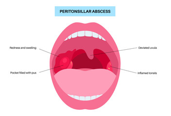 Peritonsillar abscess poster