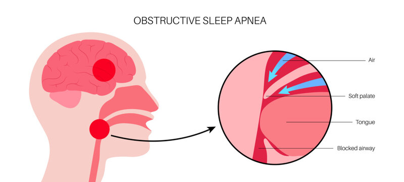 Obstructive sleep apnea - Powered by Adobe