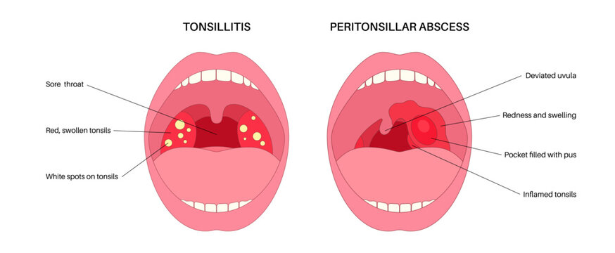 Peritonsillar abscess and tonsillitis