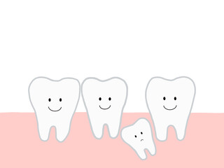 乳歯の生え変わりによる埋没歯・過剰歯と歯並びの乱れのイラスト