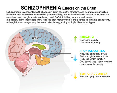 Schizophrenia- Effects on the Brain