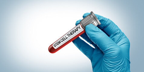 Stem Cell Donation and human regenerative treatment donating stem cells as Regenerative Medicine as Mesenchymal Cells in a test tube as a Doctor or researcher holding a glass container for joint pain.