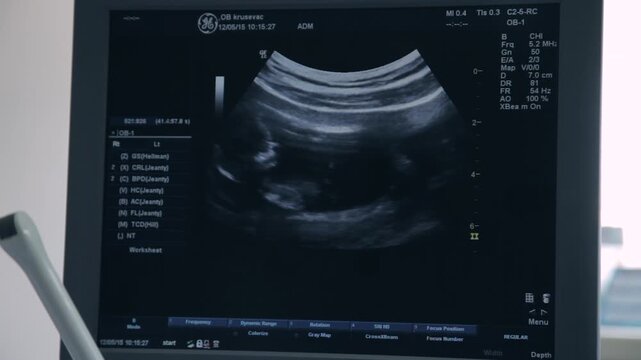 Ultrasound monitor screen showing baby fetus with gynecologist hand pointing