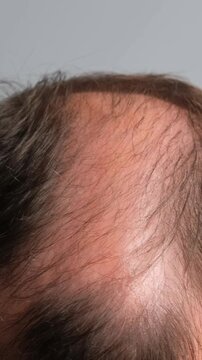 Close-up of male head with thinning hair and baldness while combing, showing receding hairline and hair loss problem. Vertical video.
