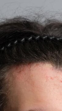 Close-up of a person s forehead with acne and irritation along the hairline, wearing a black hairband. Concept of skin problems, scalp issues, and dermatological care.