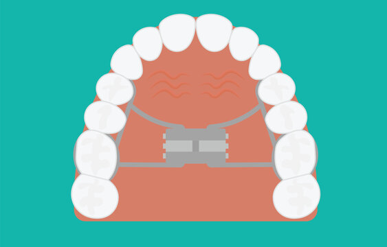 Orthodontic Palatal Expander and Human Teeth