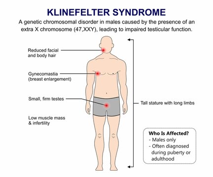 Klinefelter Syndrome Medical Flashcard Illustration