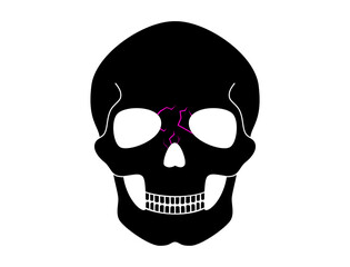 Nasal fracture poster