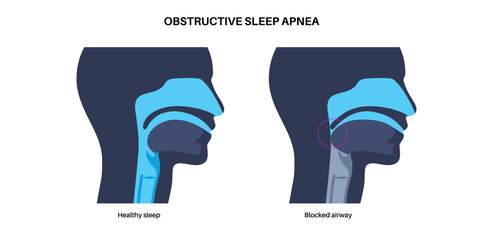Obstructive sleep apnea