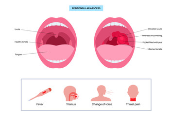 Peritonsillar abscess poster