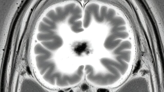 Coronal MRI scan of a human brain showing a dark central lesion, possibly indicating a pathology or abnormality.