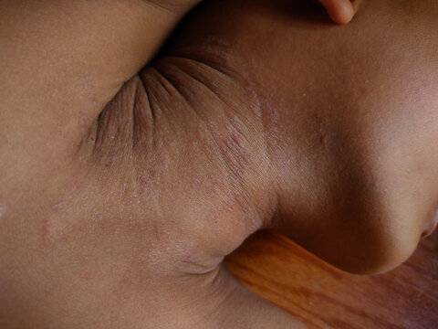 The image provided appears to show a skin condition known as&nbsp;acanthosis nigricans