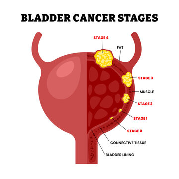 Stages of bladder cancer stages with anatomical oncology. Labeled connective tissue, fat, bladder lining. Illness growth and medical condition development vector scheme. Pathology diagnosis.