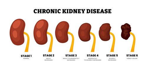 Stages of chronic kidney disease stages. From normal, mildly, moderate to kidney failure. Mildly decreased, to Kidney failure. Renal dysfunction. GFR test result. Flat vector illustration.