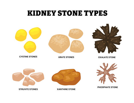 Different types of kidney stone types set collection. Labeled cystine, urate, oxalate, struvite, xanthine and phosphate stone. Deposits made of minerals and salts . Flat vector illustration.
