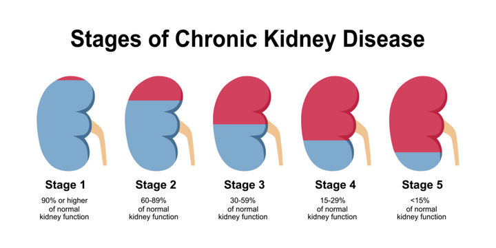 Chronic kidney disease. Stages of CKD from Healthy kidney to decreased Glomerular filtration rate and Renal failure. Vector illustration.