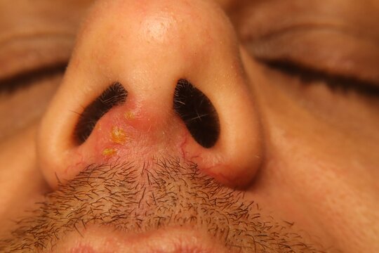 Herpes Simplex Virus type 1 (HSV-1) mouth infection with cold sores triggered after severe influenza fever and psychological stress. for medical, healthcare awareness, virology and infectious disease.