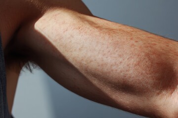 Fototapeta premium Close-Up View of a Young Man's Arm with Keratosis Pilaris: Skin Treatment and Health Care Insights