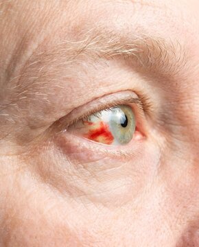 Close-up detail of a mature man's eye with subconjunctival hemorrhage, red bloodshot spot on white eyeball, medical and health concept.