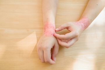 Allergic to rubber gloves, wrist Itching scratching. Itchy red rash, flea allergies, skin diseases