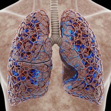 human lungs showing thick, stiffened scarred tissue and "honeycombing," symbolizing Pulmonary Fibrosis, iridescent fluid dynamics in a rigid crystalline pattern, copper and electric blue, 
