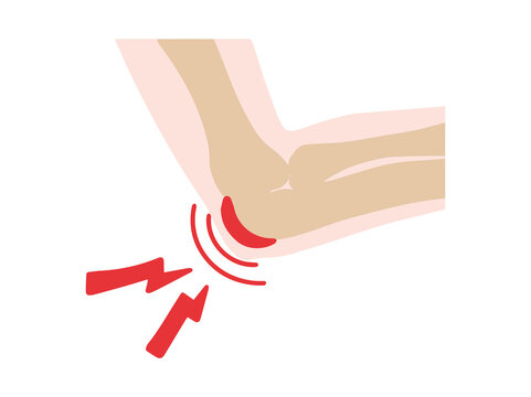 Bursitis Olecranon Disease in Elbow
