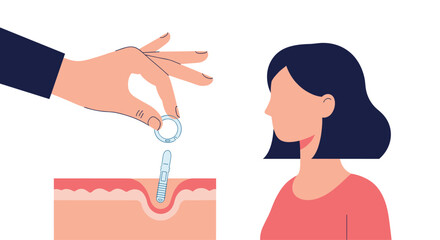 Medical illustration showing the process of placing a dental implant and crown into the jaw for a female patient.