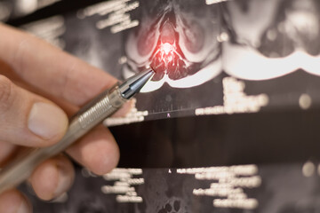 Obraz premium Doctor studying x-ray with intervertebral hernia in human spine. Close up.