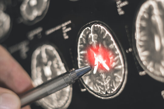 A doctor examines an X-ray of a human brain. Treatment head diseases. Close up.