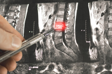 Close up view of diagnosing x-ray human spine.