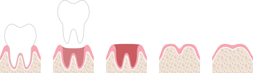 抜歯後の回復過程の図解　文字なし © 鳥屋野