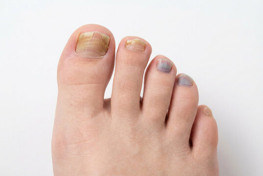 Close-up of a human foot showing various unhealthy toenail conditions: fungal infection on the big toe and subungual hematomas (bruising) on other toes