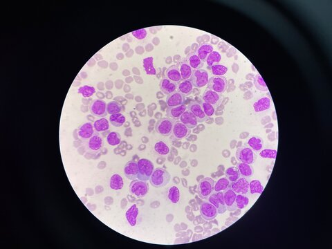 Leukemia blood smear moderate Immature cell.