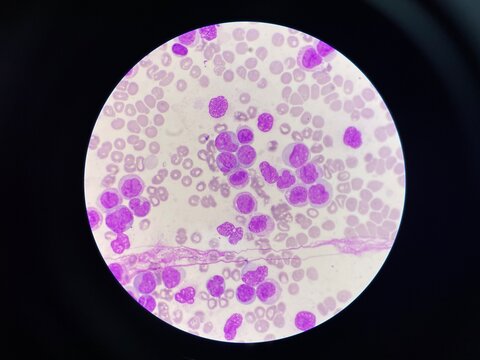 Leukemia blood smear moderate Immature cell.