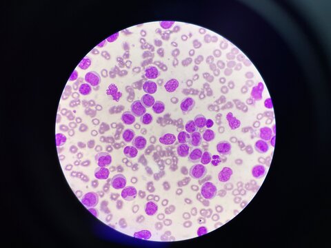 Leukemia blood smear moderate Immature cell.