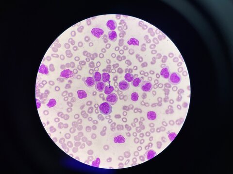 Leukemia blood smear moderate Immature cell.
