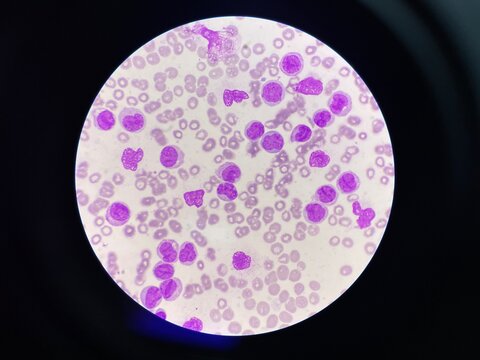 Leukemia blood smear moderate Immature cell.