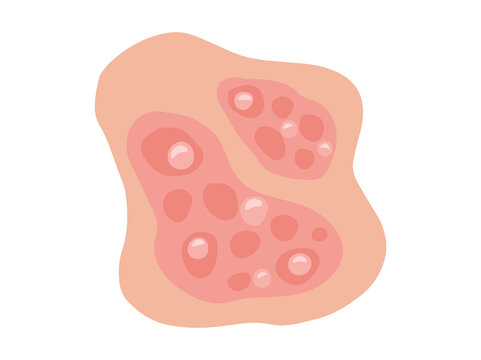 Pustular Psoriasis Disease in Skin
