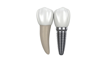 Image shows a natural tooth next to a dental implant model