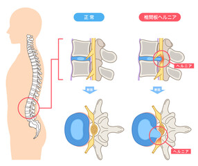 腰椎椎間板ヘルニア　椎間板の構造　腰痛