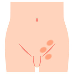 鼠径ヘルニアの種類　ヘルニア　股関節