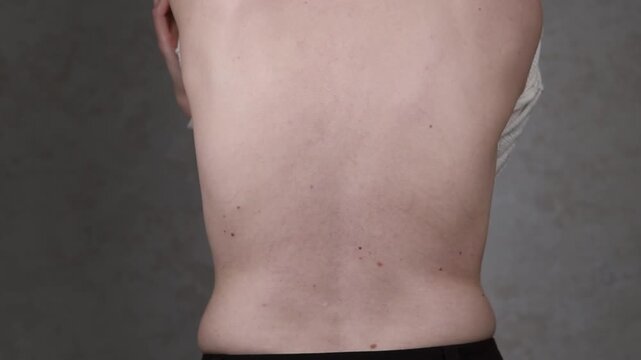 Skin spots of ring-shaped centrifugal erythema Darya on the back of a young woman