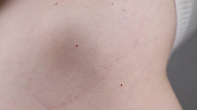 Young woman shows her skin spots on the belly. Ring-shaped centrifugal erythema of Darya