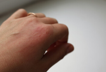 Allergic rash on the hand