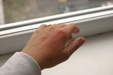 Allergic rash on the hand