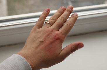 Allergic rash on the hand