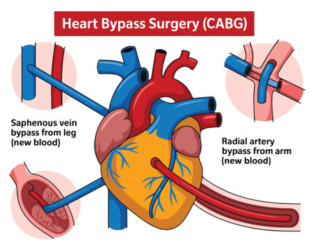 Diagram of Heart Bypass Surgery ( CABG) with Saphenous Vein and Radial Artery Grafts cabg coronary artery bypass grafting