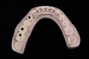 Dental bridge made of zirconium on three titanium abutments to fixation on implant