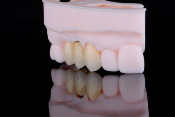 Dental crowns made of zirconium for fixation to upper jaw teeth one of them on titanium abutment © gorynvd