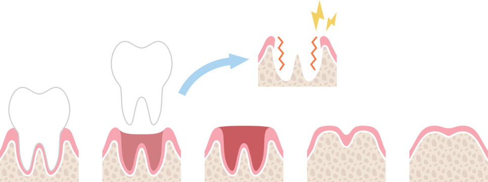 抜歯後の回復過程とドライソケットの図解　文字なし